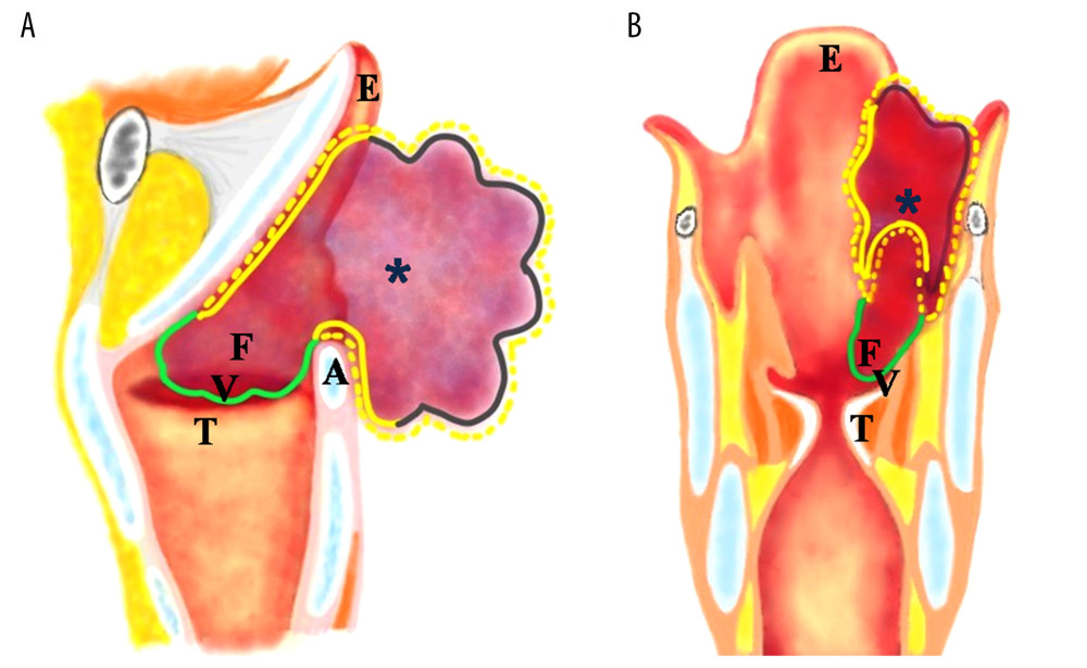 The schematic representations of the treatment options for pharyngolaryngeal hemangioma. (A) Sagittal image and (B) Coronal image. The mucosa at the margin of the hemangioma in the pre-epiglottic space, laryngeal surface of the epiglottis, pharyngoepiglottic fold, aryepiglottic fold, and arytenoid was incised (yellow dotted line). Next, the margin and hemangioma abutting epiglottis and arytenoid was dissected using the CO2 laser (yellow solid line). The hemangioma in the pharyngoepiglottic fold and aryepiglottic fold was excised using an ultrasonic scalpel (black solid line). The hemangioma in the ventricle, false vocal fold, and paraglottic space was treated by KTP laser photocoagulation until it was no longer visible under the microscope (green solid line). A – arytenoid; E – epiglottis; F – false vocal fold; T – true vocal fold; V – ventricle.