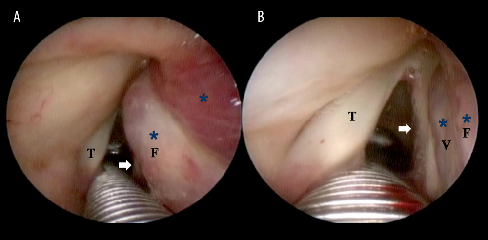 Representative intraoperative view via a suspension laryngoscopy. (A, B) The hemangioma (asterisk) was found to be occupying the false vocal fold, ventricle, and the paraglottic space on the right side, with preservation of the right true vocal fold (white arrow) and subglottis. F – false vocal fold; T – true vocal fold; V – ventricle.