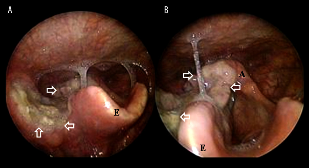 Representative postoperative laryngoscopic image 10 days after surgery. (A, B) The tumor had disappeared, crusting (open arrow) and blood clot on the lesion were observed, the mucosal edema was decreased, and there was no evidence of bleeding on postoperative day 10. A – arytenoid; E – epiglottis.