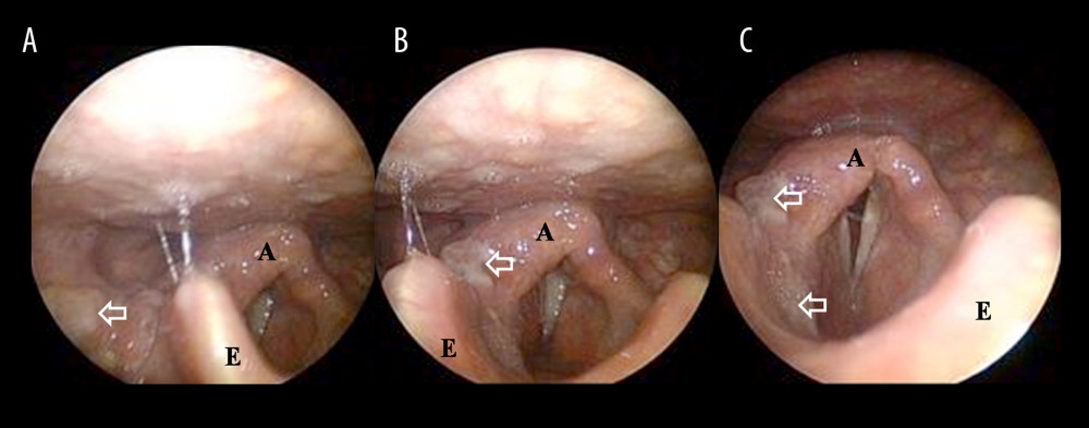 Representative postoperative laryngoscopic image 1 month after surgery. (A) A well-healed, smooth-surfaced mucosa was observed without deformity at 1 month after surgery. No recurrence of the lesion was visible. (B, C) The mobility of the vocal fold was preserved. A – arytenoid; E – epiglottis.