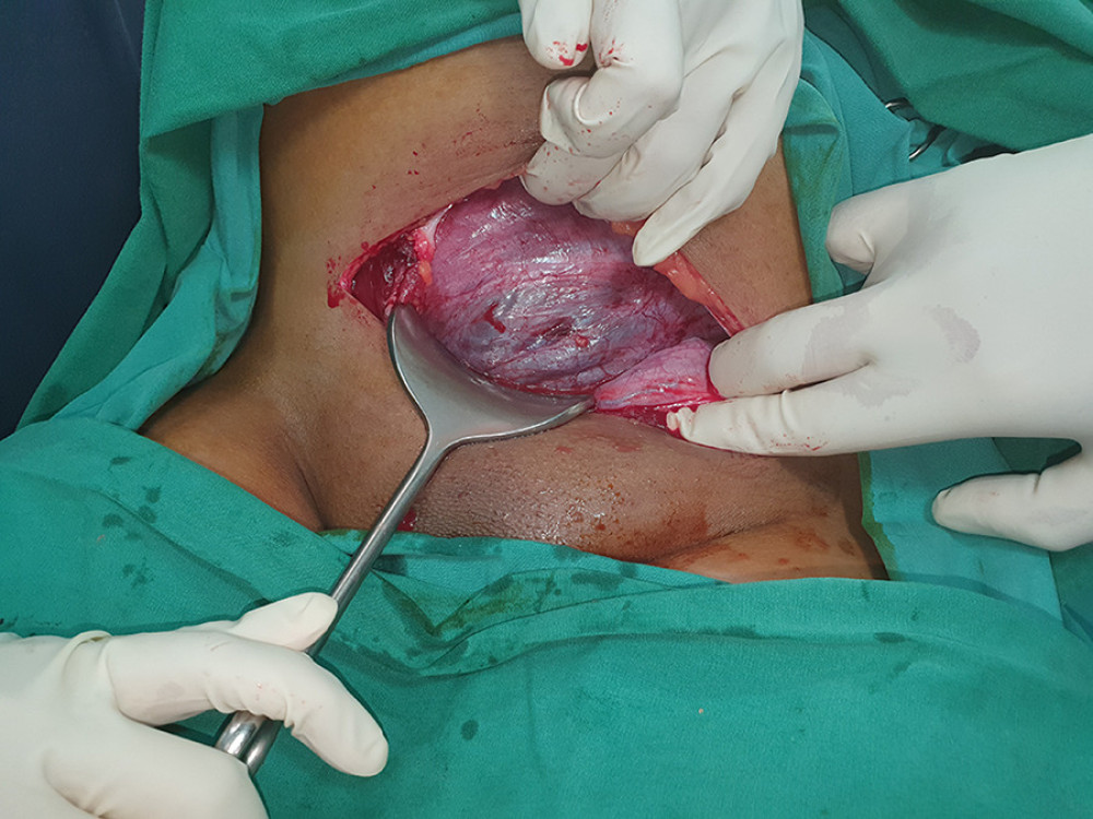 Case 1. Pfannenstiel incision with hypervascularization is observed in the lower segment of the uterus.