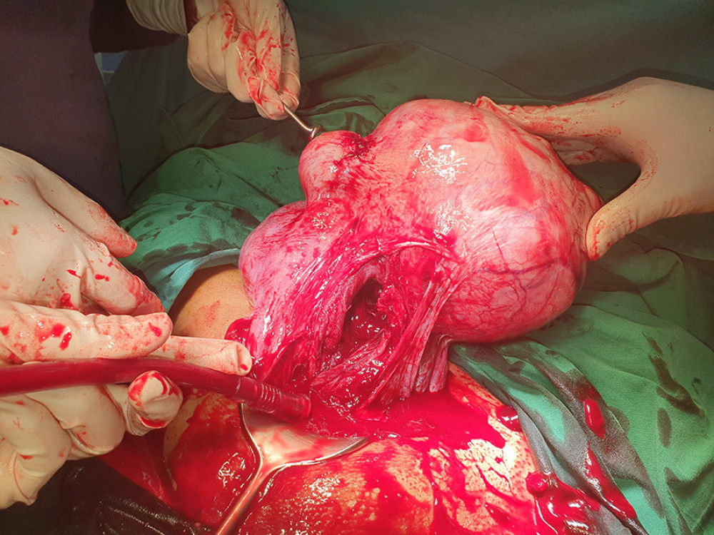 Case 1. After the baby is delivered, the uterus is exteriorized and the fibroids are observed in the uterine corpus-fundus.