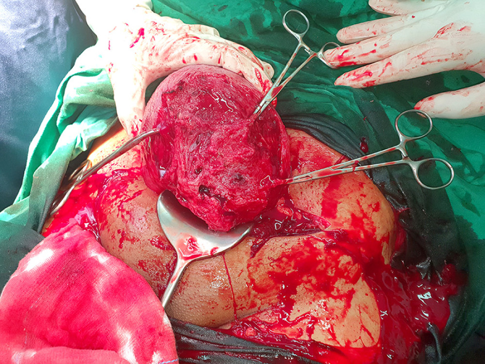 Case 1. The largest fibroid is removed through the cesarean section incision.