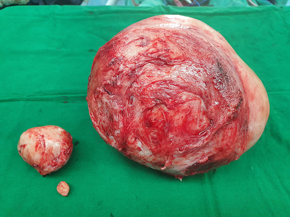 Case 1. Three fibroids were removed.