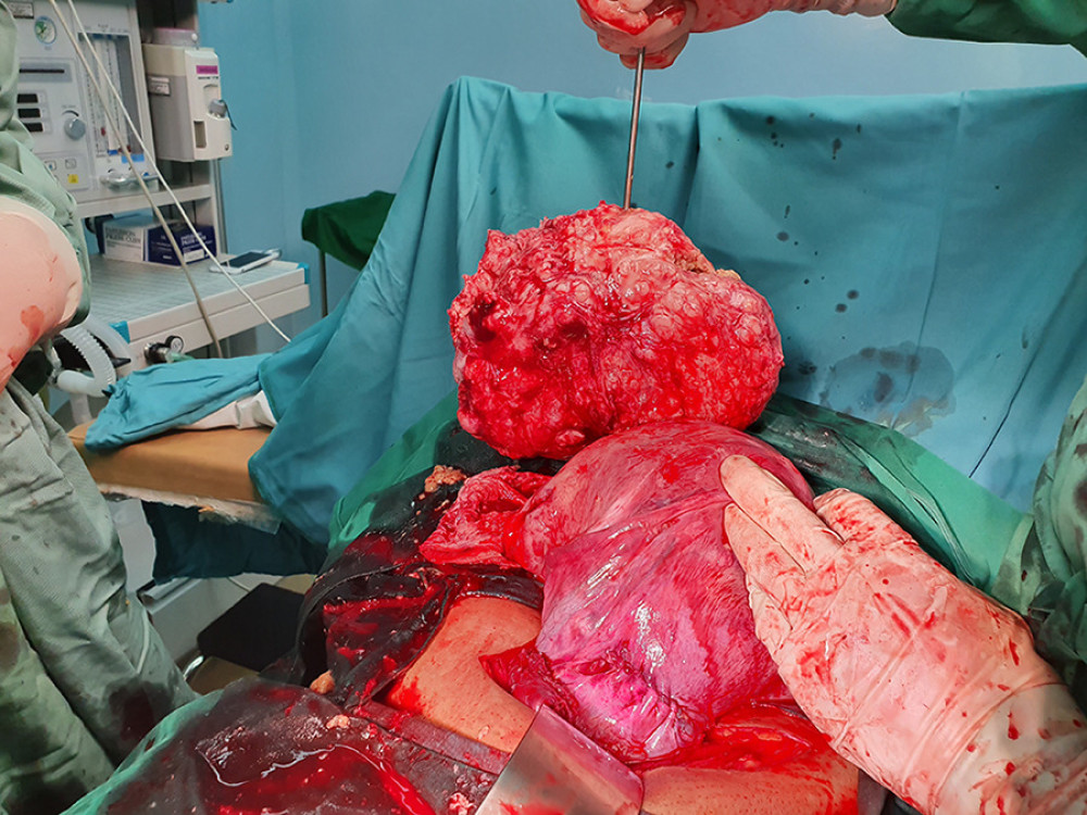 Case 2. The large fibroid is removed.