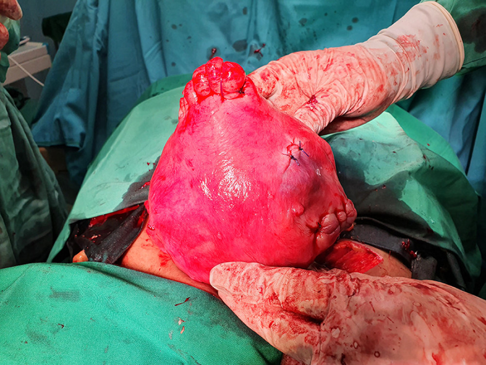 Case 2. Uterus after myomectomies.