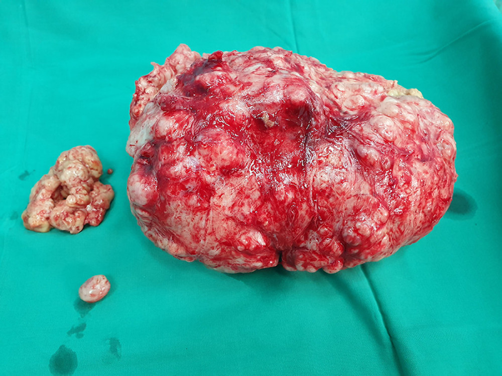 Case 2. Three fibroids were removed.