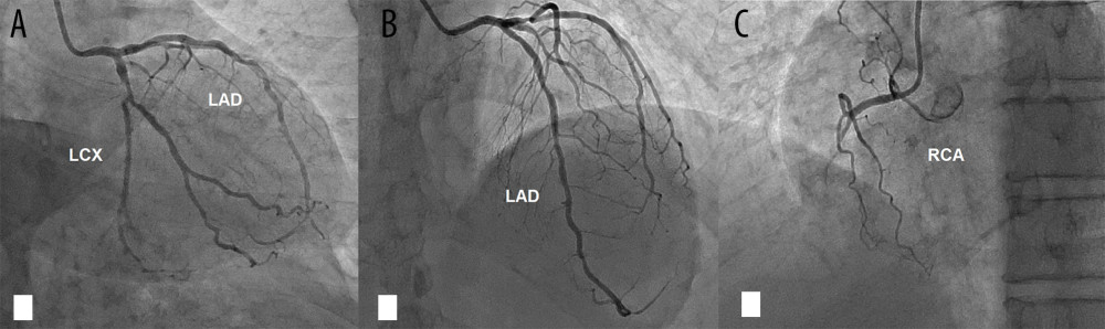 The selective coronary angiogram via the right radial artery showed a critical bifurcation disease in proximal left circumflex (LCX) involving the ostium of the first major obtuse marginal (OM) branch (A) and multiple moderate lesions through the course of the left anterior descending artery (LAD) (B). A large dominant RCA was totally occluded from mid-course (C).
