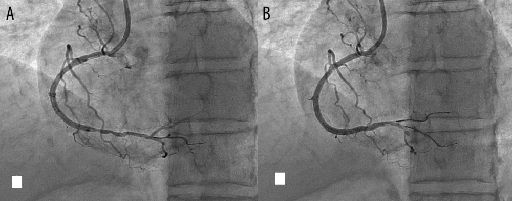 A Xience Xpedition stent (3.25×48 mm, Abbott, USA) deployed from proximal to mid-course revealing a diseased segment distally (A). Distal segment was covered by Promus Element, 2.75×32 mm (Boston Scientific, USA.) after parking the Runthrough guidewire in posterior left ventricular artery (PLV) and balanced middle-weight guidewire in posterior descending artery (PDA) (B).