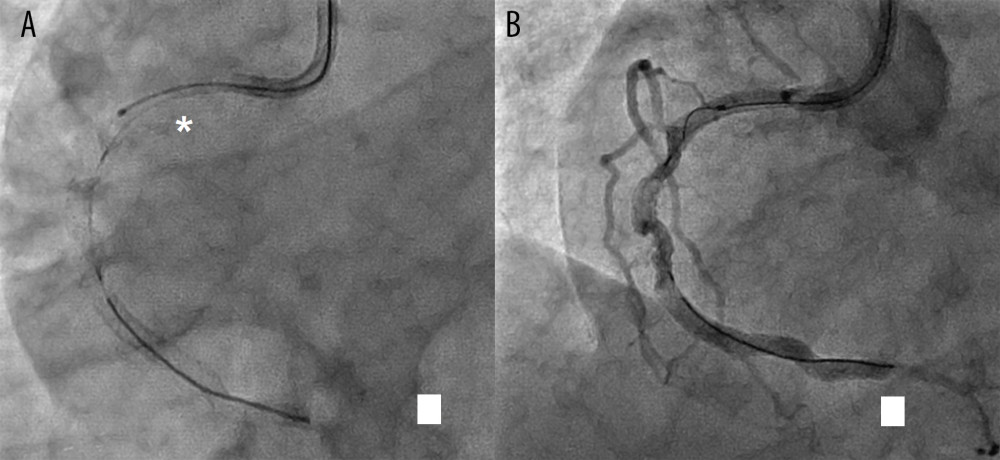 Runthrough guidewire trapped between the overlapping stents after post-dilation by Sapphire NC, 3.25×18 mm non-compliant balloon (OrbusNeich, Hoevelaken, Netherlands.) (A). While maneuvering to pull the wire, the guide catheter deformed the proximal stent after deep cannulation of the right coronary artery (RCA) (B). * Microcatheter.