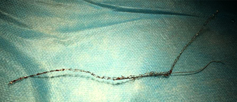 Retrieved stent after arteriotomy and subsequent coronary artery bypass graft surgery (CABG).