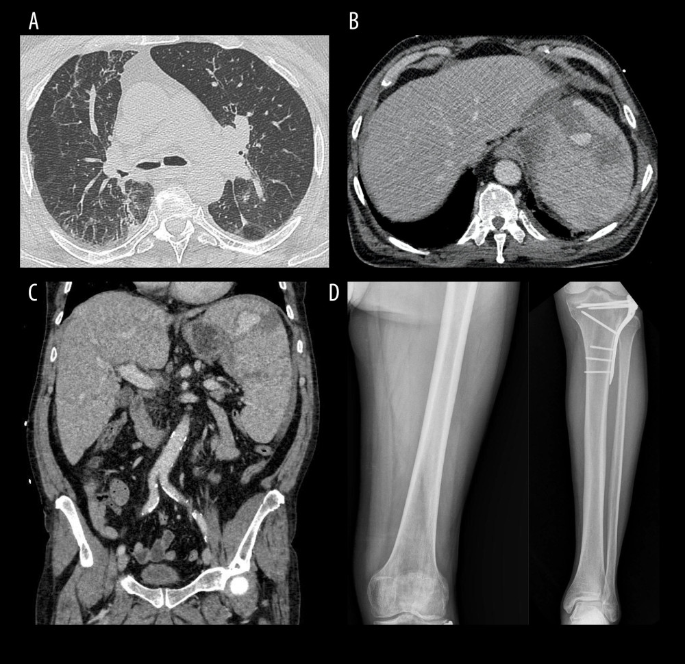 Contrast-enhanced computed tomography scan: (A) The coronal reformatted image (lung window) showed nonspecific peri-bronchial thickening and focal areas of parenchymal consolidation involving the lower lobes. (B) On the coronal reformatted image, there is evidence of perisplenic hematomas seen as a diffuse fluid collection surrounding the spleen, with no mass effect to adjacent parenchyma. (C) An axial image shows an irregular hypodense area caused by splenic laceration (confirmed intraoperatively) and demonstrates a focal area of high attenuation in the splenic parenchyma due to active extravasation. (D) Antero-posterior radiographs of left femur and leg show normal appearance of bone marrow and regular thickness of the cortical bone with plate osteosynthesis at the proximal-third of the tibia from a previously healed fracture.