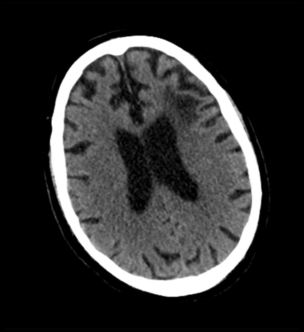 Noncontrast brain computed tomography scan shows cortico-subcortical chronic infarction of the left frontal lobe.