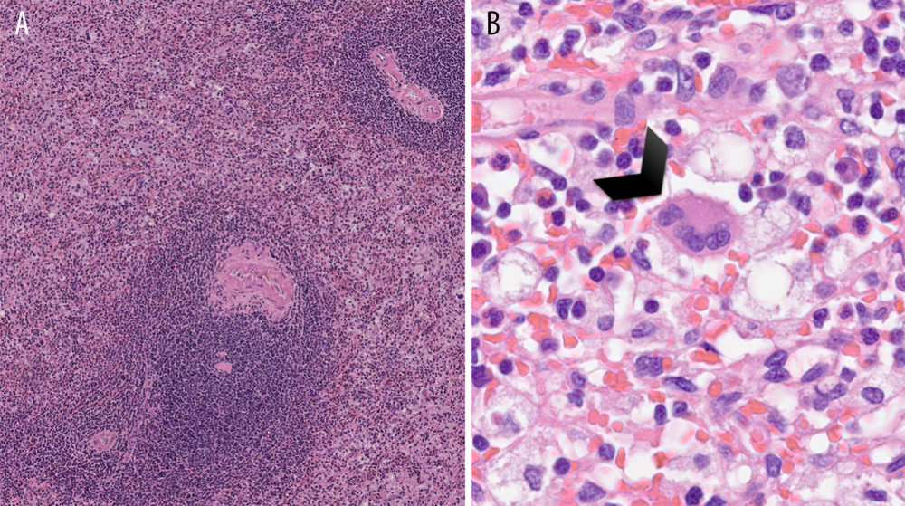(A) Hematoxylin 7×. Splenic parenchyma with a preserved architecture and areas of hemorrhagic extravasation and an expanded red pulp. (B) Hematoxylin 60×. In the context of an expanded red pulp, a diffuse proliferation of histiocytes with a pale staining, foamy and finely granular cytoplasm and minimal nuclear pleomorphism was seen, which was occasionally associated with scattered, multinucleated cells, resembling Touton giant cells (black arrowhead). In the background, a mixed inflammatory infiltrate composed of plasma cells, small lymphocytes, and eosinophils was recognized.