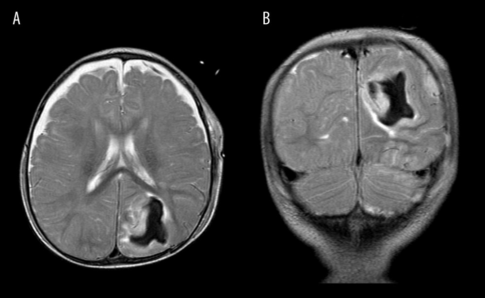 Brain MRI without contrast. Axial T2 (A) and coronal T2 (B) indicating a left parietooccipital intraparenchymal hematoma.