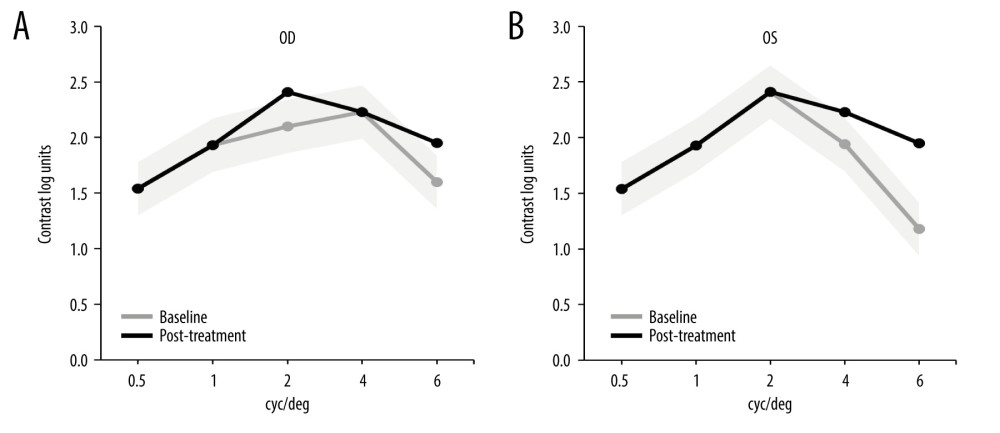 Contrast sensitivity measures. Graph representing contrast sensitivity in the right eye (OD – oculus dexter) (A) and left eye (OS – oculus sinister) (B) at baseline (gray line) and after treatment (black line). Gray shaded area represents the coefficient of repeatability, COR±0.24 logits.