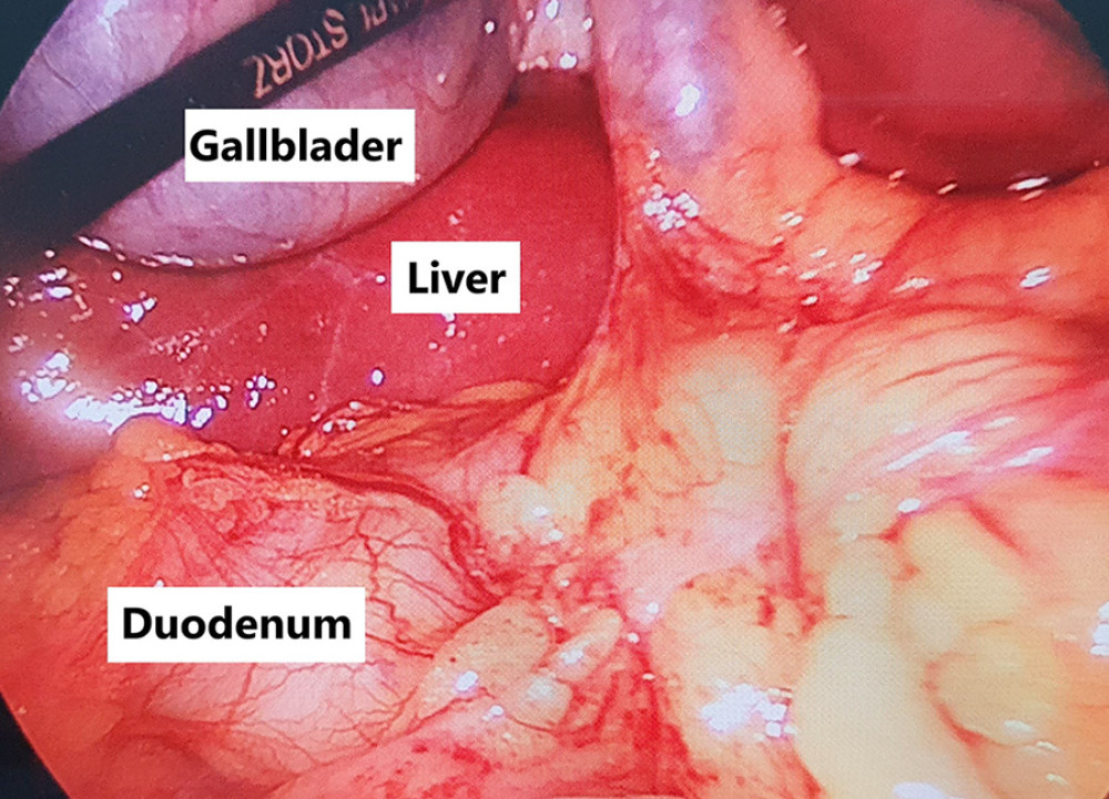 Surgical findings. During abdominal surgery, the gallbladder, liver, and duodenum were normal.