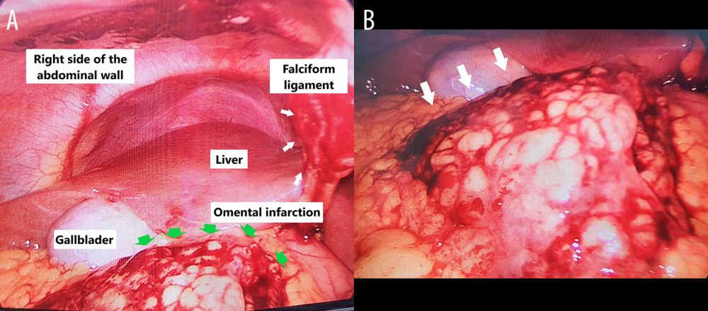 (A) Laparoscopic surgical findings. During abdominal exploration, a solid, ischemic portion of the greater omentum (green arrows) was found adhered to the right side of the abdominal wall and falciform ligament (white arrows). (B) The surgical findings show a portion of the omental infarction (white arrows).