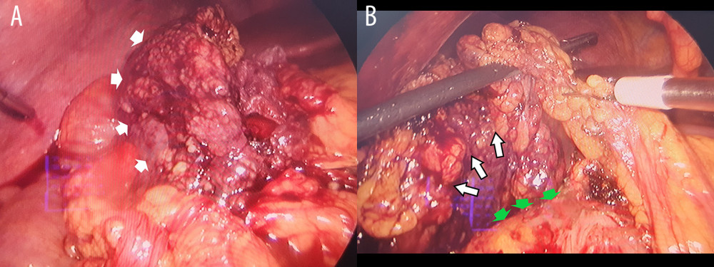 (A) Surgical findings. A portion of the greater omentum (white arrows) is ischemic. (B) Laparoscopic omentectomy. The omental infarction (white arrows) has been dissected from the right colic flexure (green arrows).