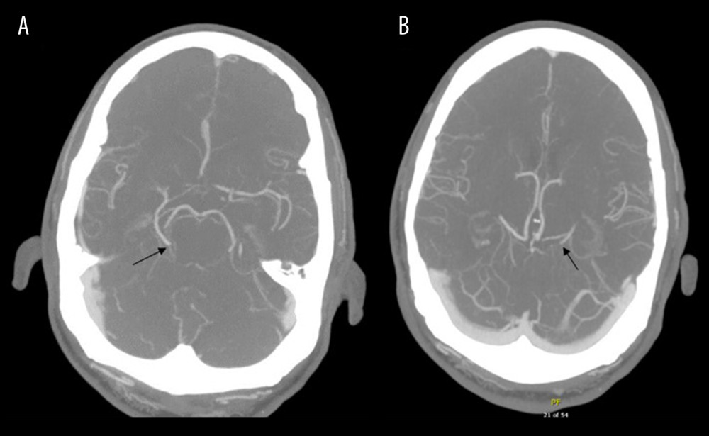 Computerized tomography angiogram of the head and neck. The black arrows point to the (A) right P2 and (B) left P3 posterior cerebral artery focal occlusions.