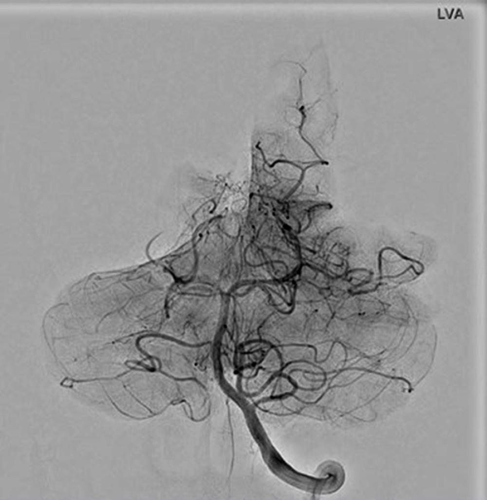 Cerebral angiogram post-pharmacological thrombectomy. Superselective microcatheter intra-arterial administration of tissue plasminogen activator resulted in reperfusion of the bilateral posterior cerebral artery (PCA) occlusions, with significant improvement of the antegrade flow within the corresponding PCA vascular territories.