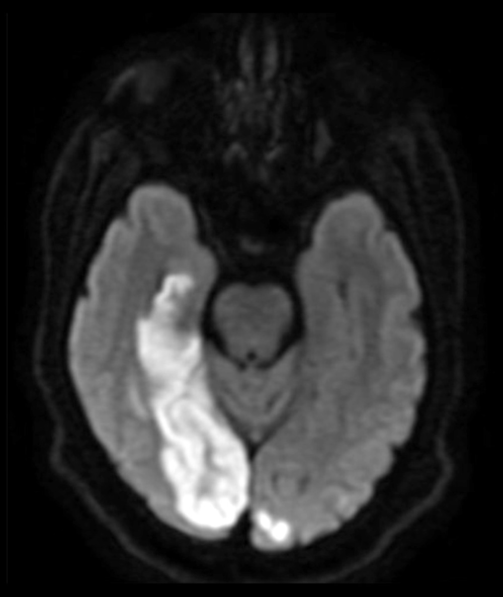 Magnetic resonance imaging (MRI) of the brain. A post-intervention MRI of the brain confirmed bilateral posterior cerebral artery (PCA) infarcts, very limited in extension at the level of the left PCA vascular territory.
