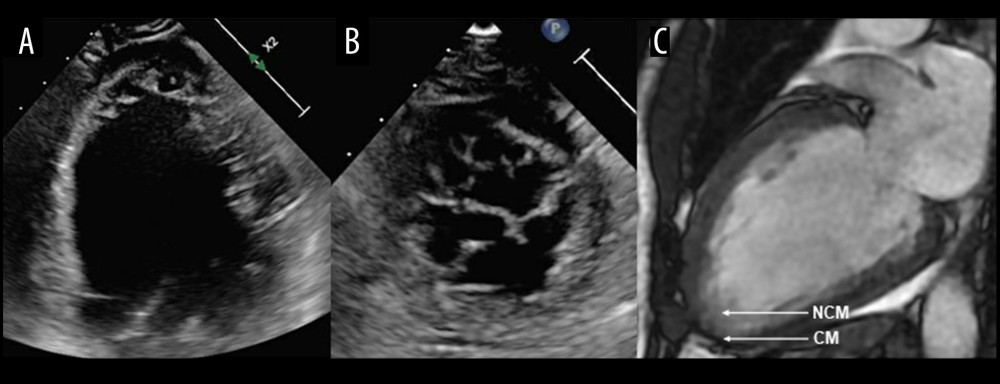 A 2D echocardiogram showed severely reduced left ventricle (LV) function and prominent trabeculations consistent with left ventricular noncompaction (LVNC), and cardiac MRI revealed severely reduced LV function with focal LVNC. (A, B) 2D echocardiogram showing (A) end-diastolic apical 4-chamber view, and (B) a short axis view demonstrating reduced LV function and prominent apical trabeculations. (C) In the end-diastolic frame of the cardiac MRI, the ratio of noncompacted myocardium (NCM) to compacted myocardium (CM) was greater than 2.3 at the apex, consistent with LVNC.