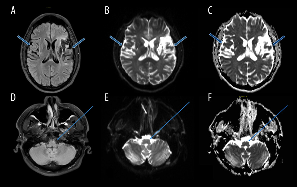Brain magnetic resonance imaging (MRI); T2-weighted fluid attenuated inversion recovery (FLAIR, A), diffusion-weighted imaging (DWI) sequences (B), which showed encephalomalacia pattern with cortical and subcortical abnormal signal intensity, volume loss, and gliosis involving bilateral MCA territories, more evident on the left side, with no evidence of restriction in DWI & ADC map (C) keeping with old ischemic infarcts. T2-weighted fluid attenuated inversion recovery (FLAIR, D) showing focal area of high signal intensity in flair image at the left anterior medulla oblongata with no evidence of restriction in DWI & ADC map (E, F) respectively, in keeping with an old insult.