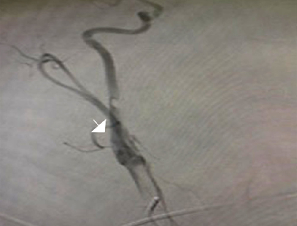 Cerebral angiogram Imaging showed incidental finding of the left internal carotid web with stasis of the contrast.