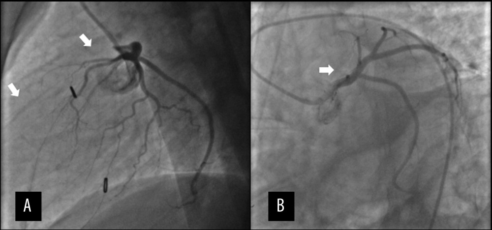 Coronary Angiogram Imaging: Lateral view (A), left anterior oblique and caudal view (B) of the left coronary system showing absences of the left anterior descending artery.