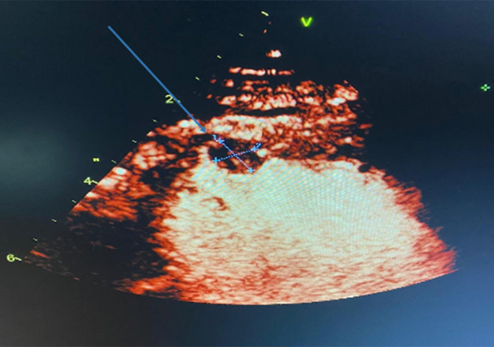 Echocardiogram showing left ventricular apical thrombus.