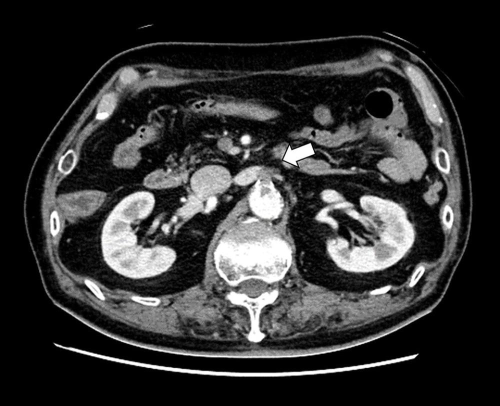 Contrast-enhanced computed tomography revealed that the root of the superior mesenteric artery (SMA) was completely occluded with a thrombus (arrow).
