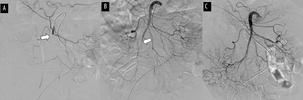 (A) Before interventional therapy, the superior mesenteric artery (SMA) was completely occluded (arrow). (B) After the treatment, the main thrombus in the root of the SMA was removed, but the SMA branch was still occluded (arrow). (C) After prostaglandin E1 and heparin therapy, the blood flow to the SMA was completely restored.