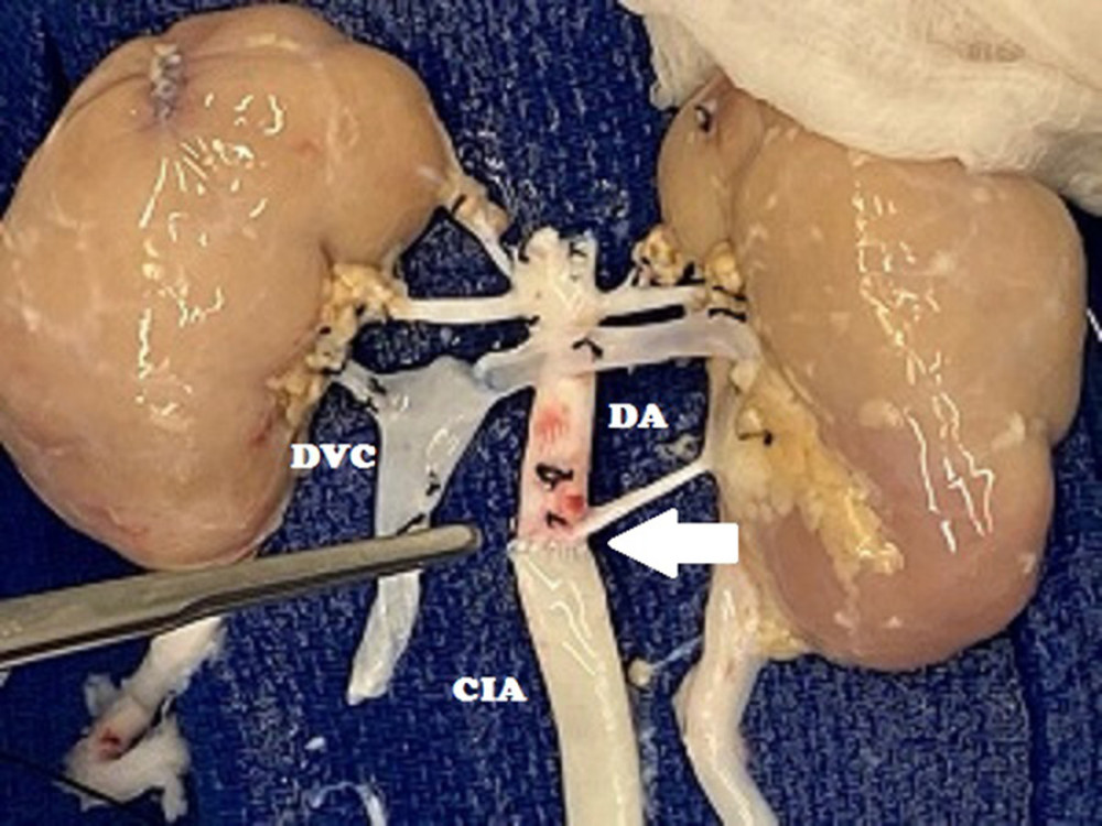 Back-table vascular reconstruction of the 2-month-old en bloc kidneys with end-to-end anastomosis between donor aorta and common iliac arterial graft (white arrow). DVC – donor vena cava; DA – donor aorta; CIA – common iliac artery graft.