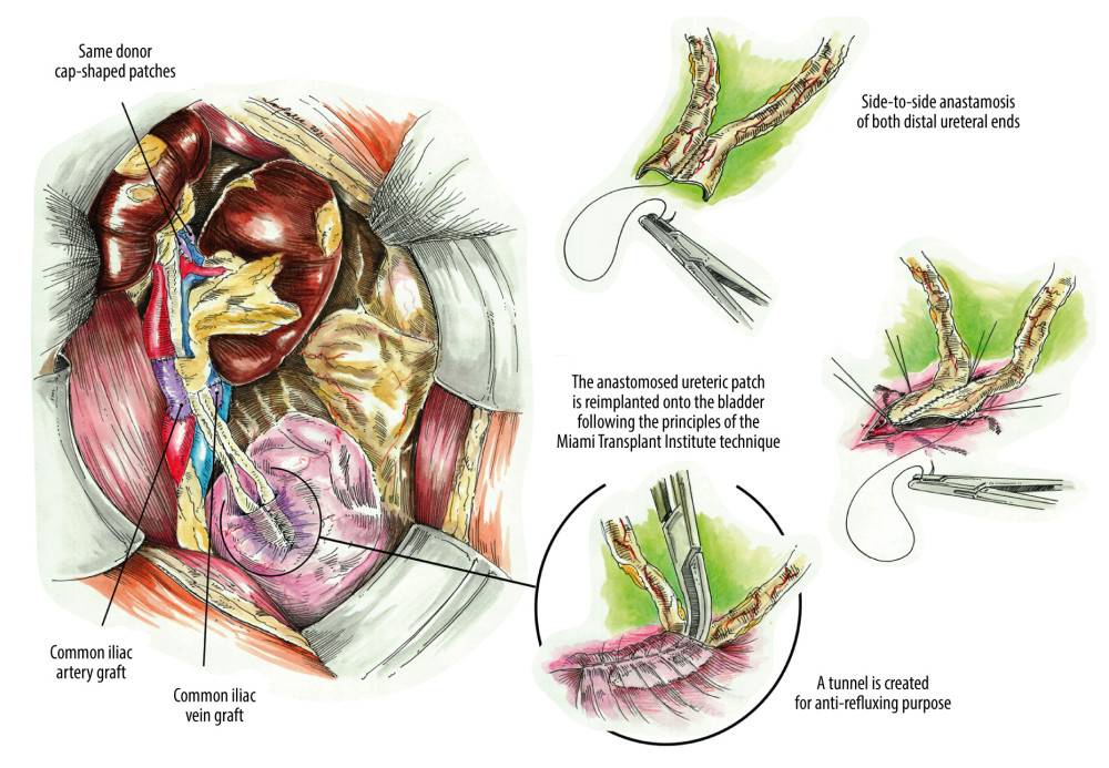 Visual of the arterial anastomosis, venous anastomosis, ureteral preparation, and anastomosis according to the Miami Transplant Institute technique.