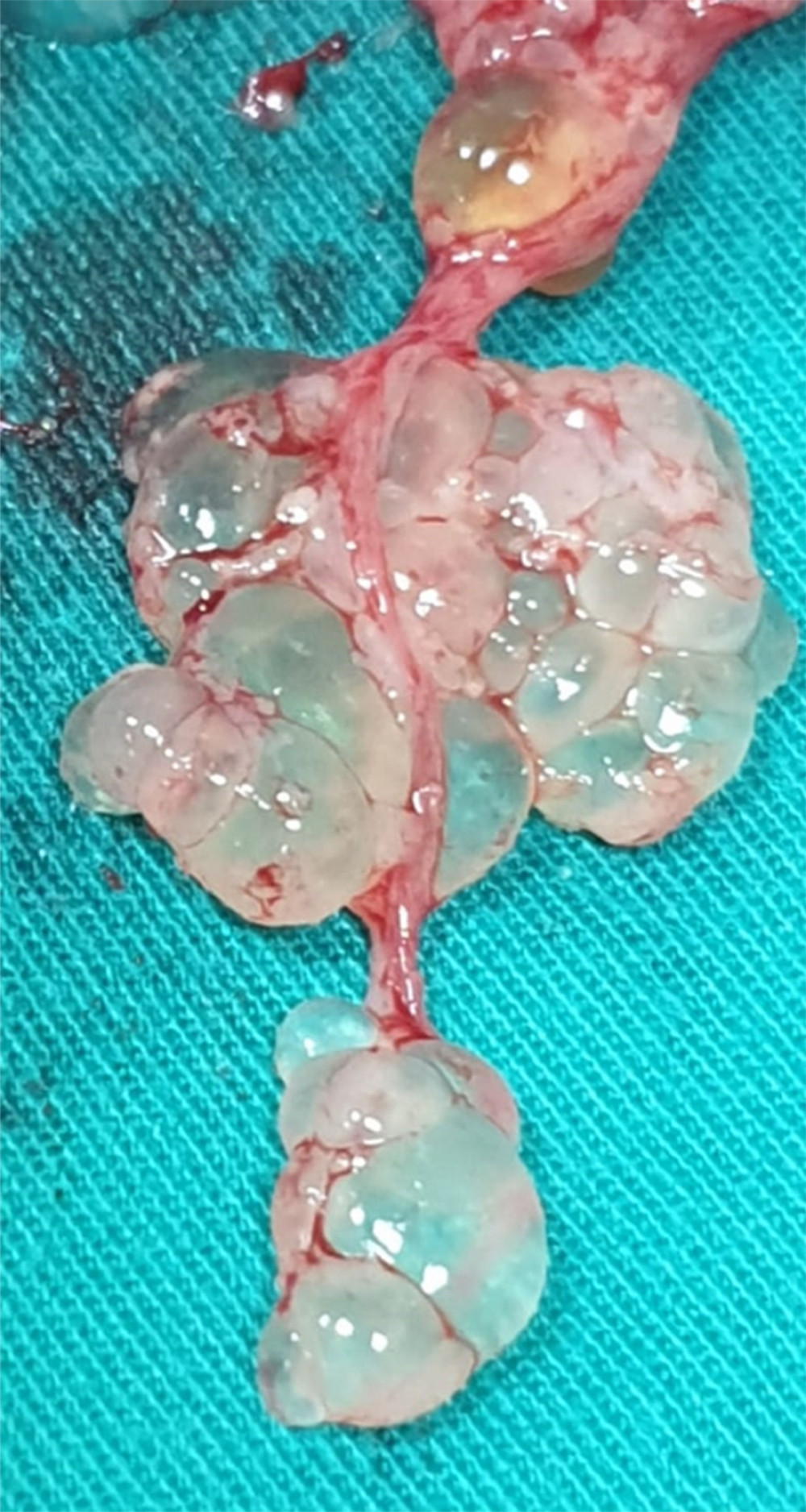 Macroscopic picture of complete hydatidiform mole suction evacuation and curettage procedures showed mole bubbles.