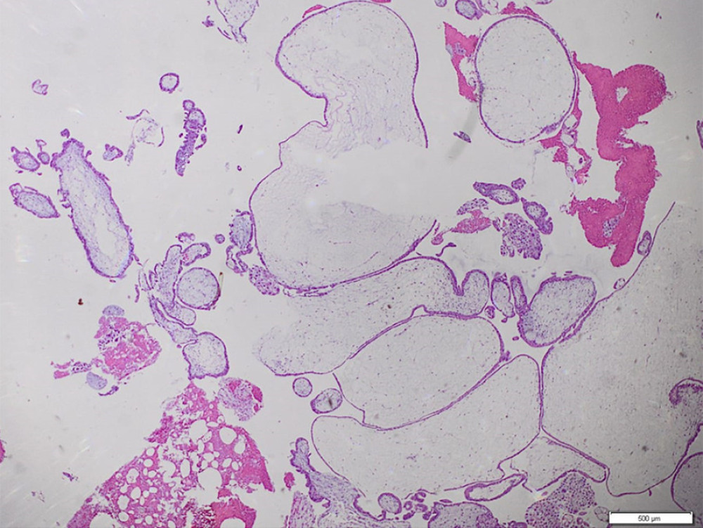 Microscopic image of complete hydatidiform mole showing chorialis villi experiencing hydrophilic degeneration of avascular scalloped form and accompanied by the formation of cisterns lined with proliferative cytotrophoblast cells.
