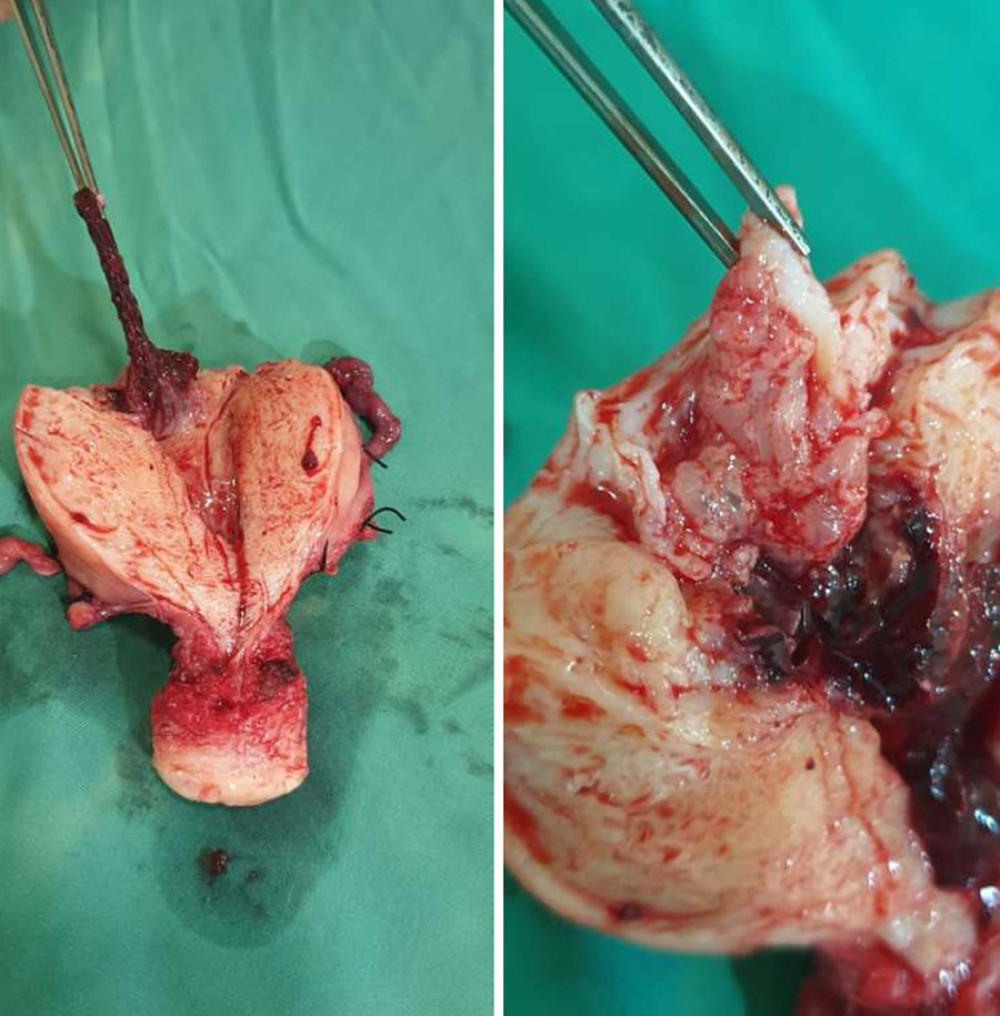 Macroscopic image of uterus with invasive mole in the fundus.