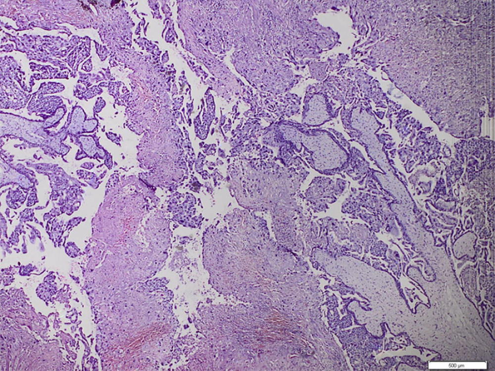 Microscopic image of invasive mole showing chorialis villi that are lined with hyperplastic trophoblast cells and have invaded the myometrium. The villous fibrovascular stroma is partly hydrophilic, with avascular degeneration.