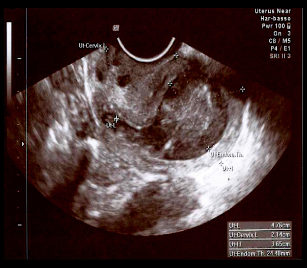 Transvaginal ultrasonography: retroverted uterus, length: 47.6 mm (body)+21.4 mm (cervix), height: 36.5 mm, with an endometrial thickness of 24.4 mm.