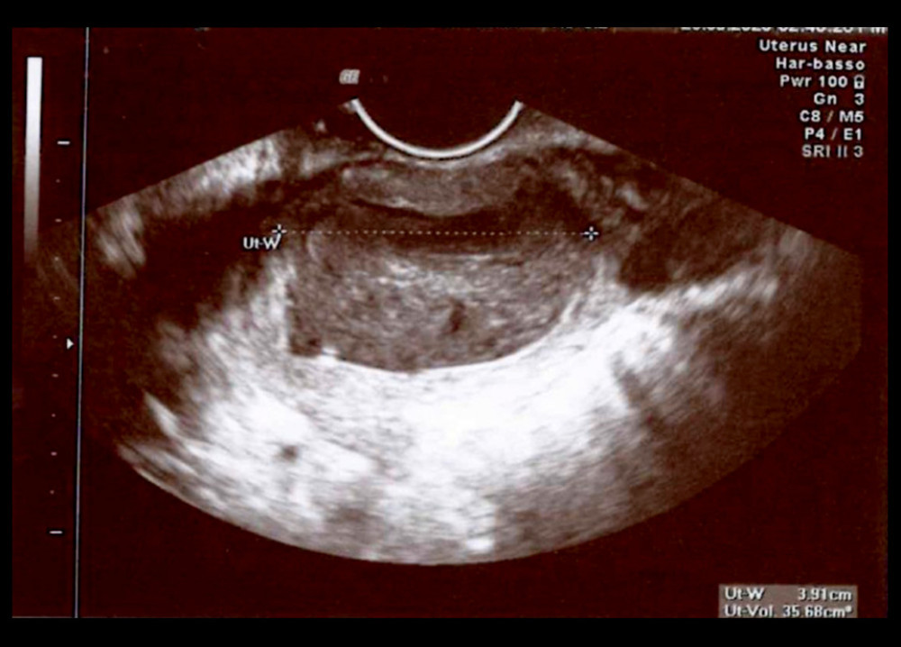 Transverse plane of the uterus. Uterus width: 39.1 mm.