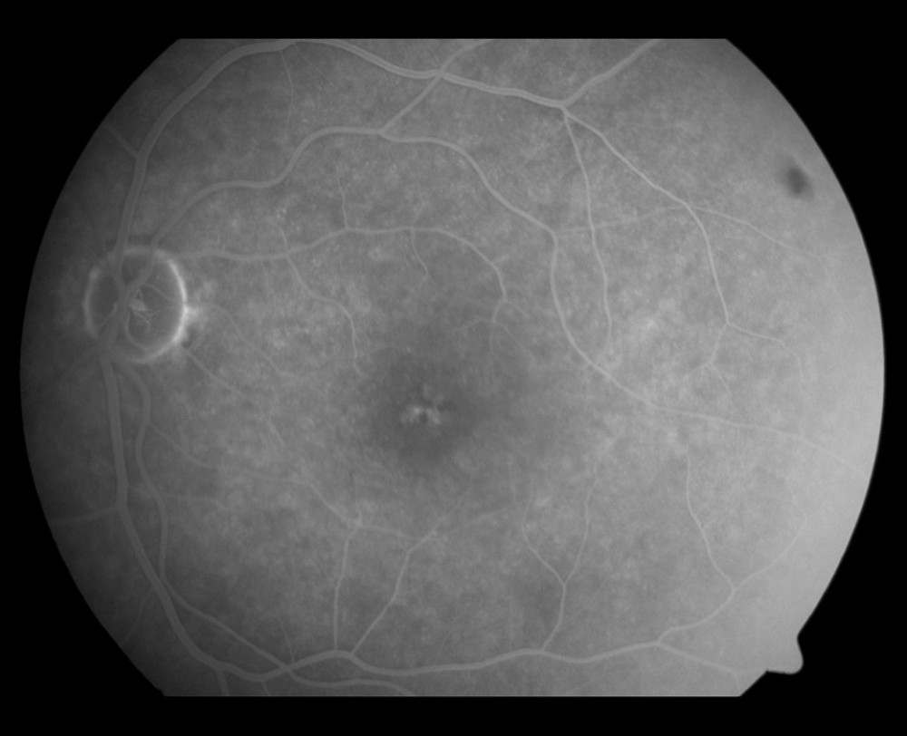 Fluorescein angiography of the left eye showed a hypofluorescent fovea surrounded by irregular hyperfluorescent defects, suggestive of acute macular neuroretinopathy.