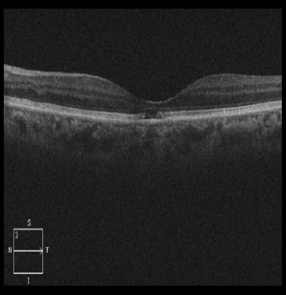 Spectral-domain optical coherence tomography of the left eye showed central foveal thinning with disrupted interdigitation and ellipsoid zones, suggestive of acute macular neuroretinopathy.