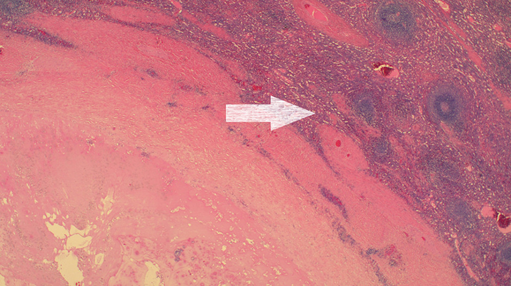 Histologic slide: The calcified cyst wall (white arrow). Scolices cannot be found in inactive cysts.