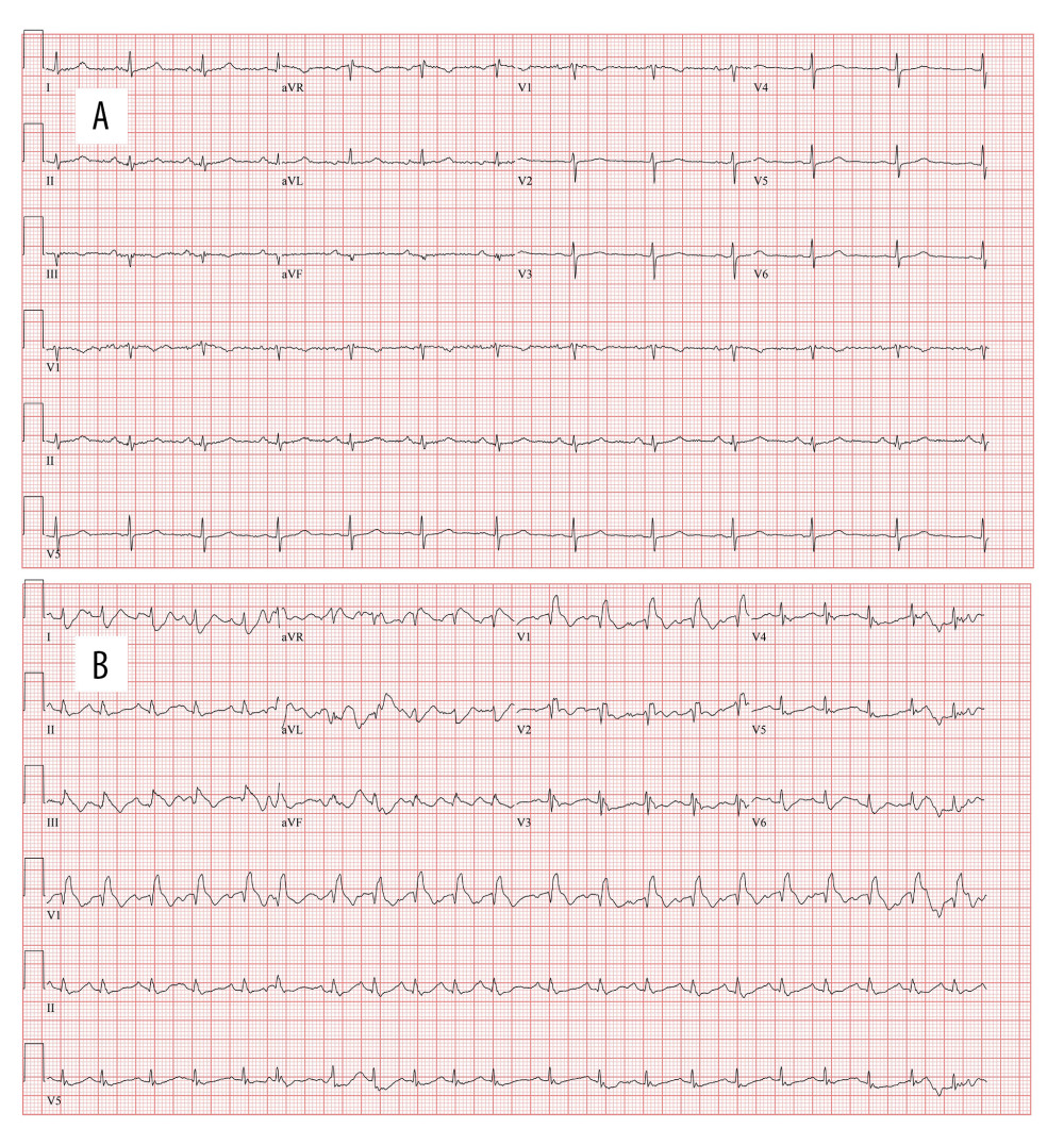 (A) Baseline and (B) post-arrest electrocardiograms.