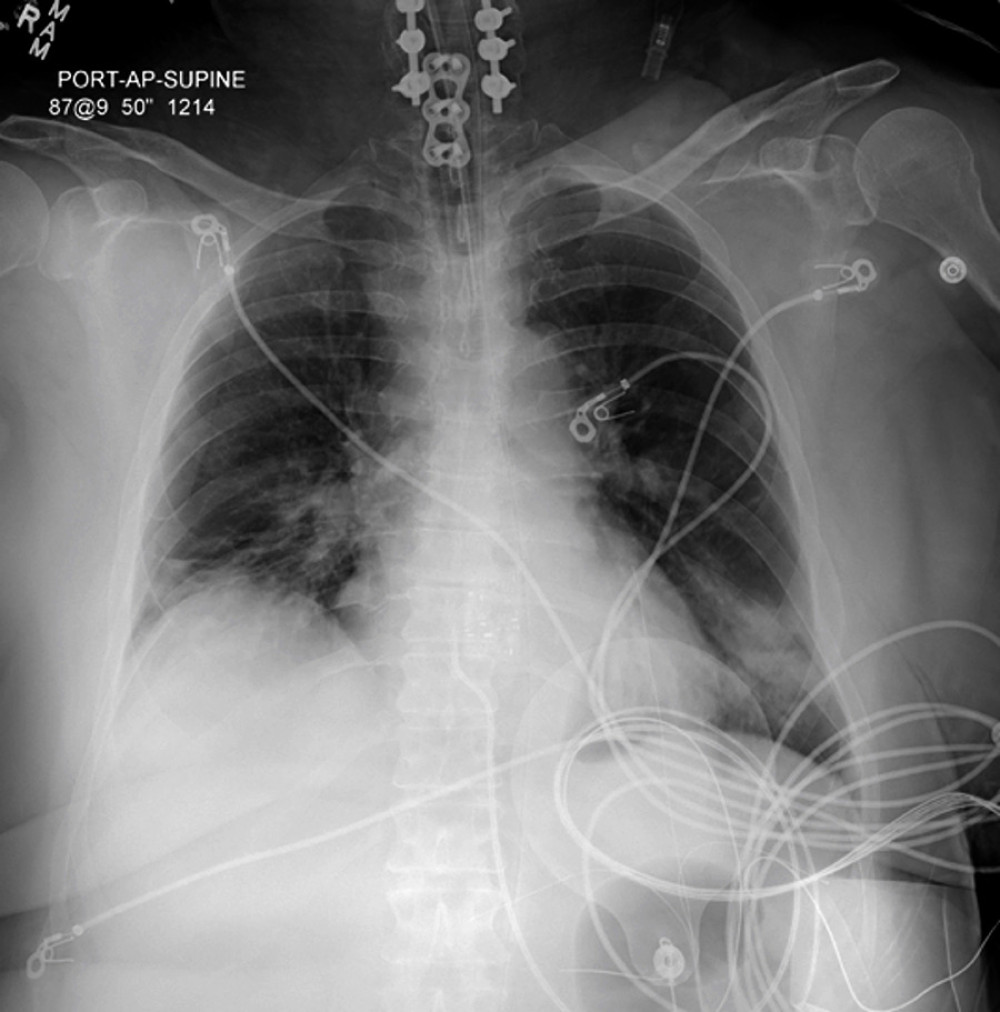 Chest X-ray following intubation and resuscitation for cardiac arrest.