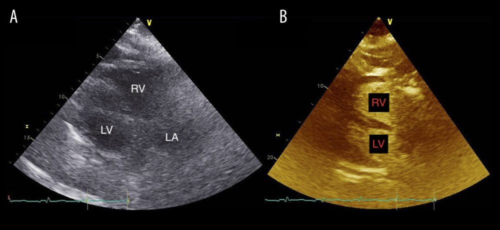 Representative parasternal long axis echocardiograms (A) with contrast augmentation and (B) demonstrating right ventricular dilatation.