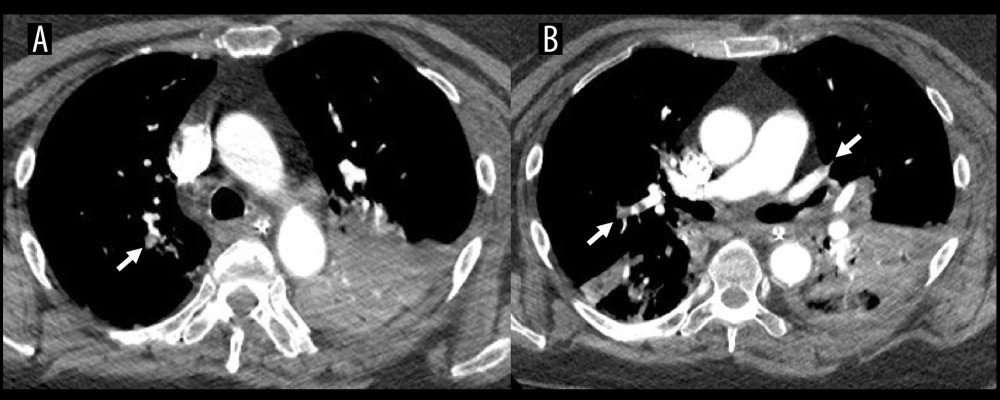 Representative image slices from a computed tomography angiogram with residual thrombi in the (A) right upper lobe (arrow) and (B) both lower lobes (arrows).