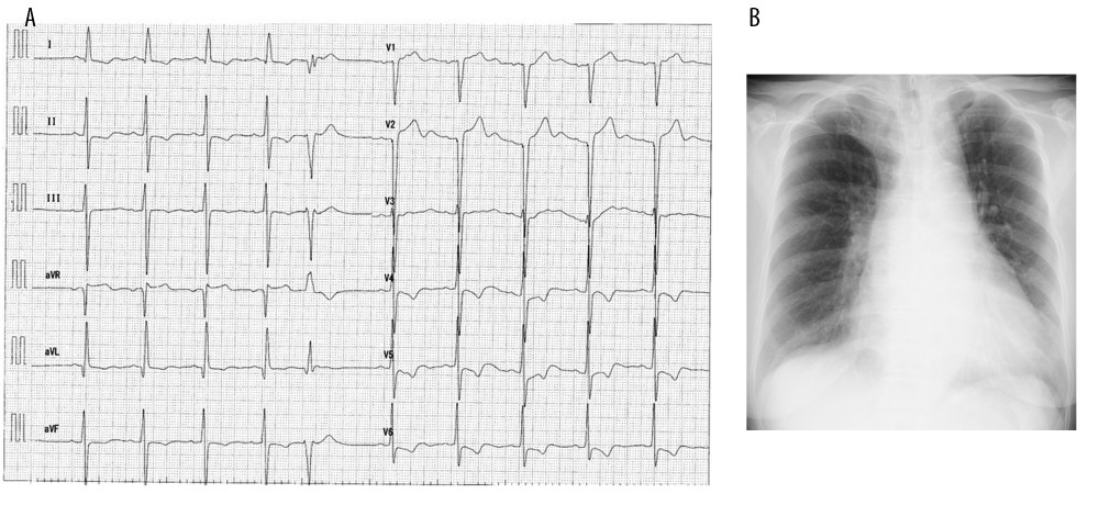 (A) Electrocardiogram on first admission. Normal sinus rhythm with the left branch anterior bundle block. ST-T change shows left ventricular hypertrophy. Occasional ventricular premature complexes are present. R-R interval reveals 960 ms. (B) Chest X-ray on first admission. No pleural effusion is found. Cardiac hypertrophy is revealed.