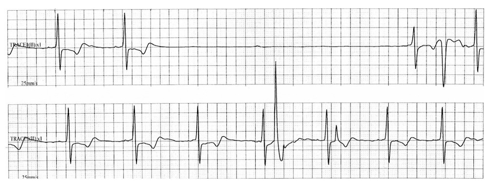Monitoring electrocardiogram showing prolonged R-R interval (6040 ms), which indicated sick sinus syndrome.